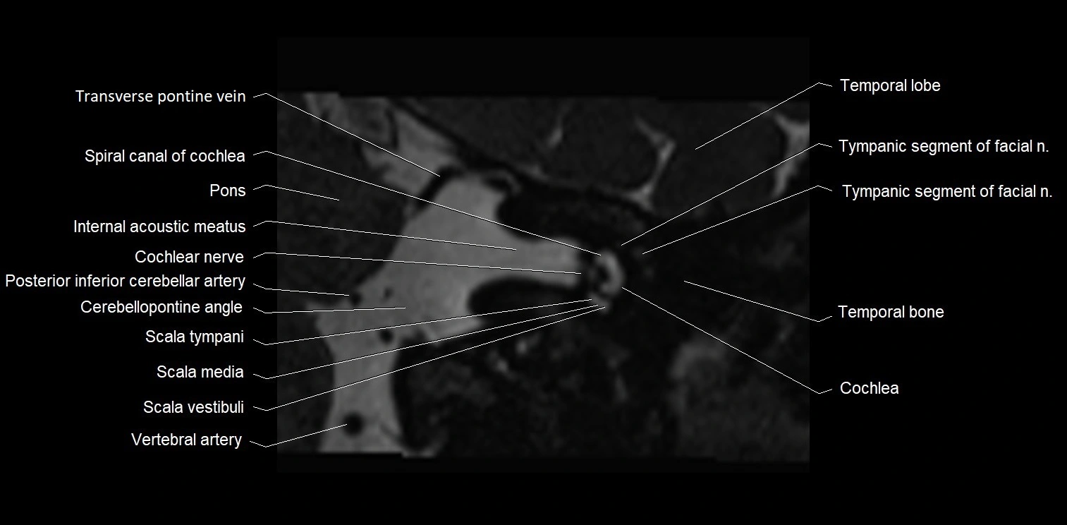 MRI Internal auditory meatus (IAM) coronal cross sectional labelled anatomy image 8.webp